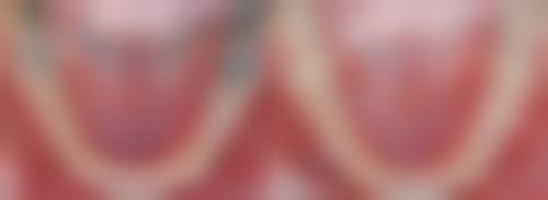 珠海牙科做全口牙橋幾多錢2026？拱北3間香港人愛平靚正單顆幾錢？