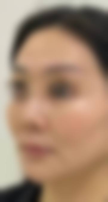韓國埋線拉提會唔會下垂更嚴重 診所揀選要點