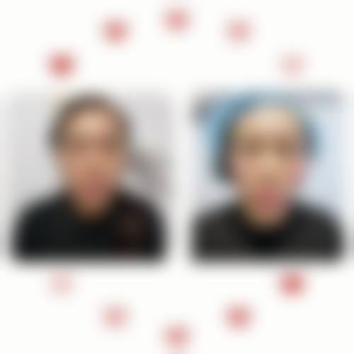 拓展延伸：韓國埋線拉提項目真相 + 避坑指南