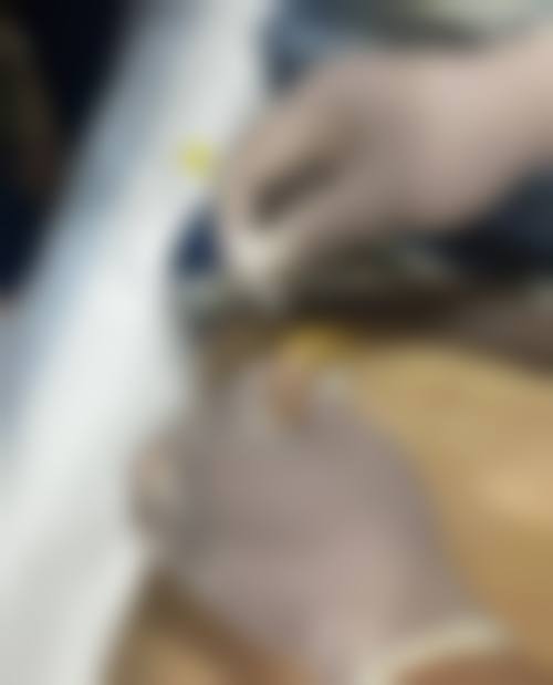 韓國埋線拉提會唔會下垂更嚴重？醫生拆解5大隱憂！副作用/後遺症2026真實案例公開