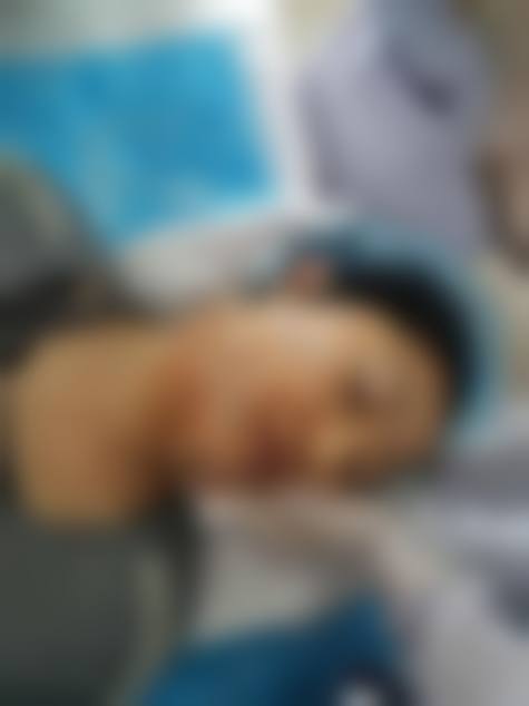 韓國埋線拉提會唔會下垂更嚴重 5大隱憂拆解！