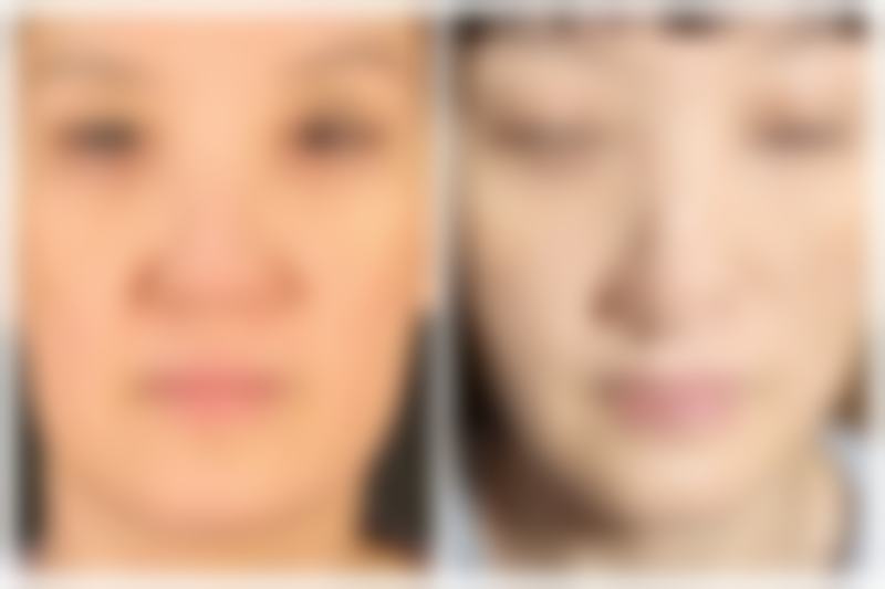 韓國鼻整形真實心得2026：鼻翼縮3mm/7天拆線無痕！鼻基底新方式術後隨意揉捏？