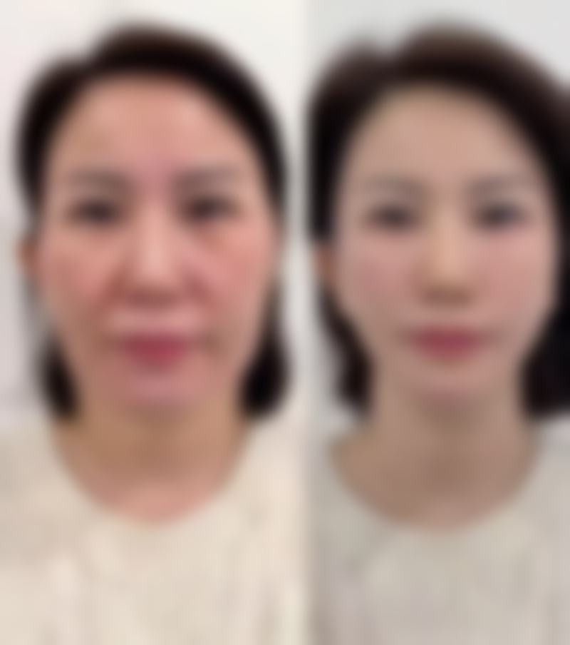 韓國鼻整形真實心得:價錢範圍(HKD)