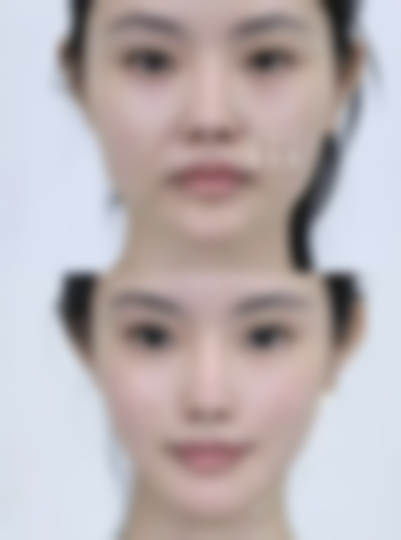 韓國鼻整形真實心得:常見誤區解答
