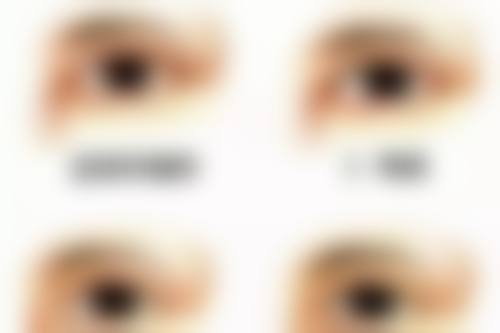临床实例分享 原晓玲 天津中 医 药大学第二附属医院眼科