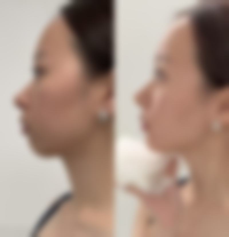 韓國必妩輪廓手術好唔好 診所揀選要點(香港 + 澳門)