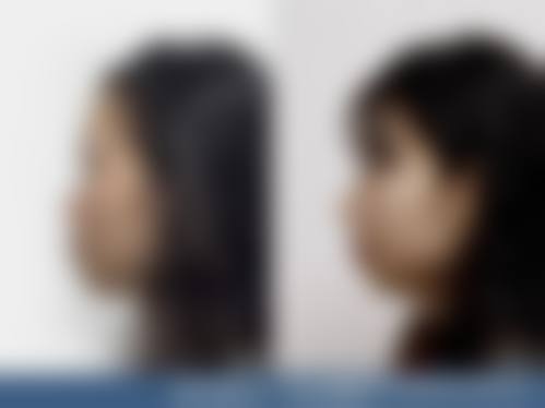 拓展延伸：韓國鼻整形不透光必知3件事