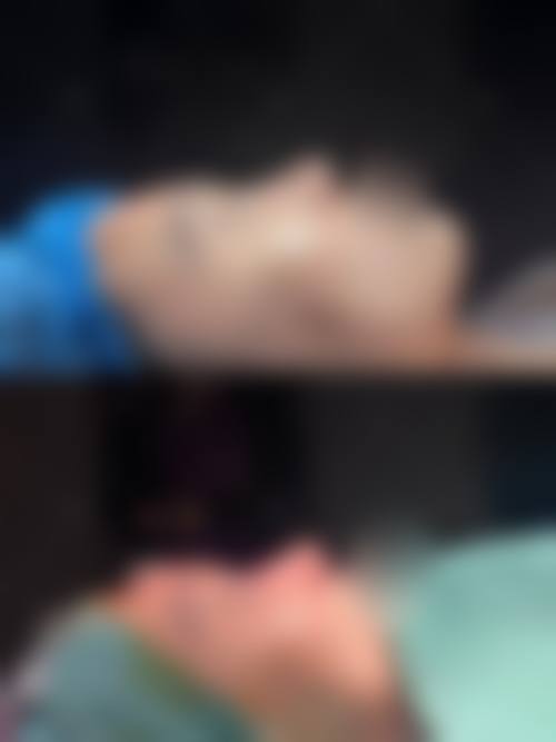 韓國鼻整形會唔會透光 診所揀選要點（香港vs澳門）