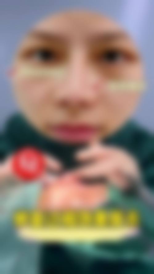 崔宰源醫生話你知：不透光鼻整形3大秘訣