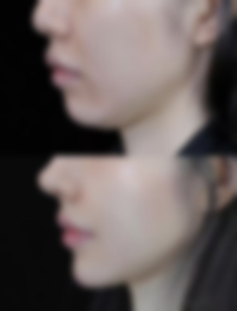 韓國整形醫院真實評價lihkg:香港人必知避坑指南